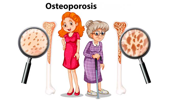 como prevenir la osteoporosis en la menopausia